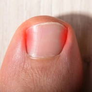 Удаление вросшего ногтя, резекция ногтевой пластины